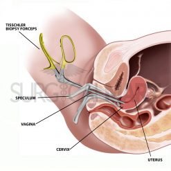 tischler-cervical-biopsy-surgical-procedure-surgicalmart