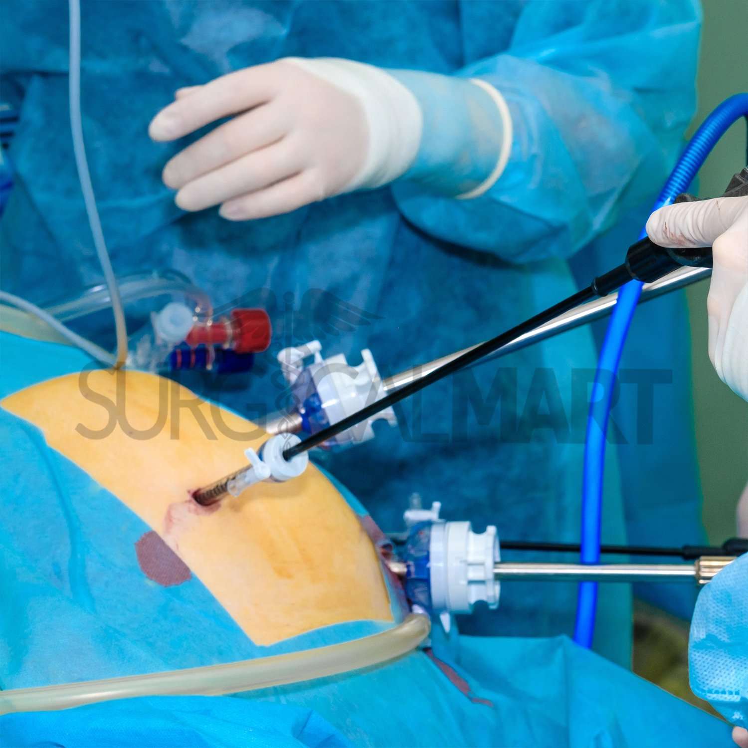 laparoscopic-surgical-procedure-surgicalmart (2)
